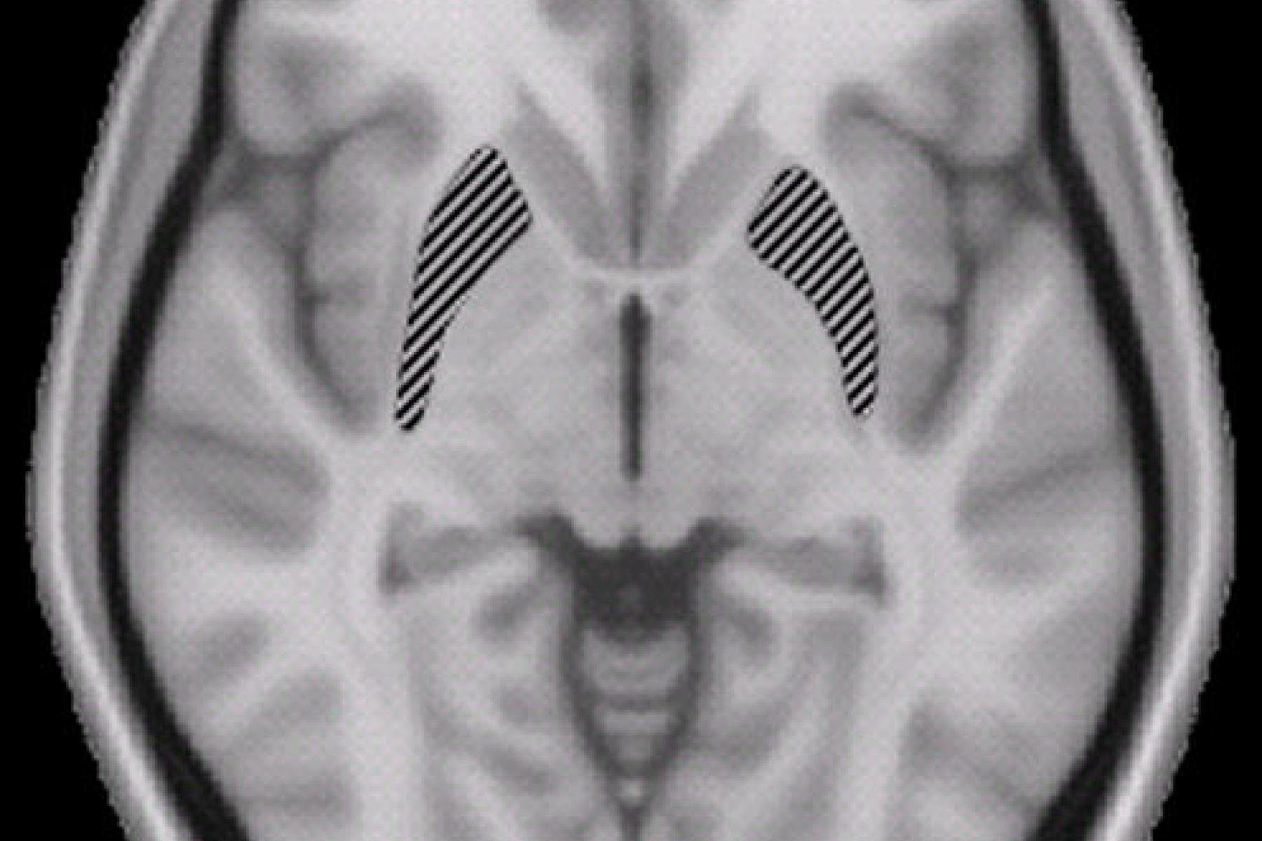 Image of a brain taken by a MRI